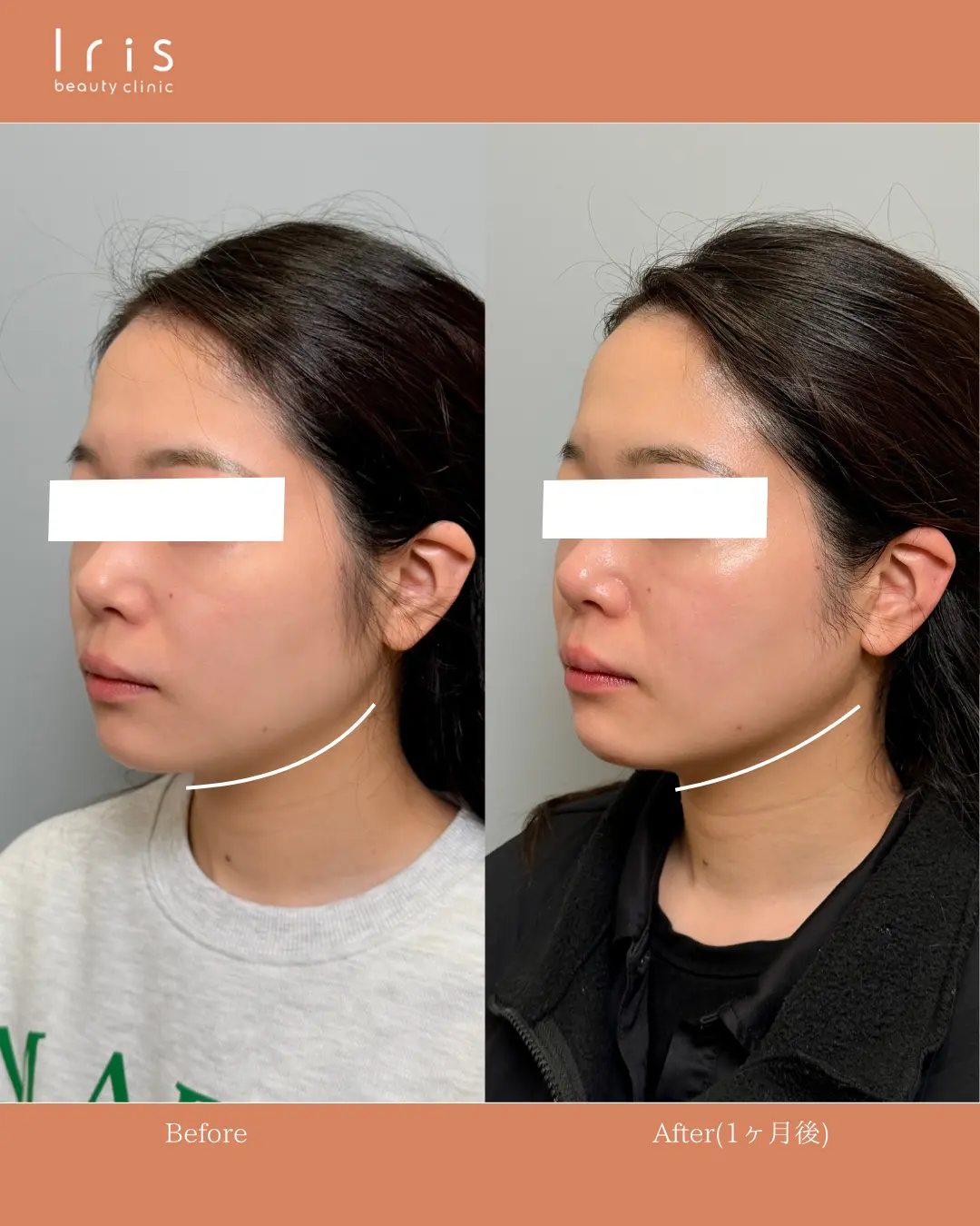 オリジオKISS(RF)300ショット×HIFUの症例