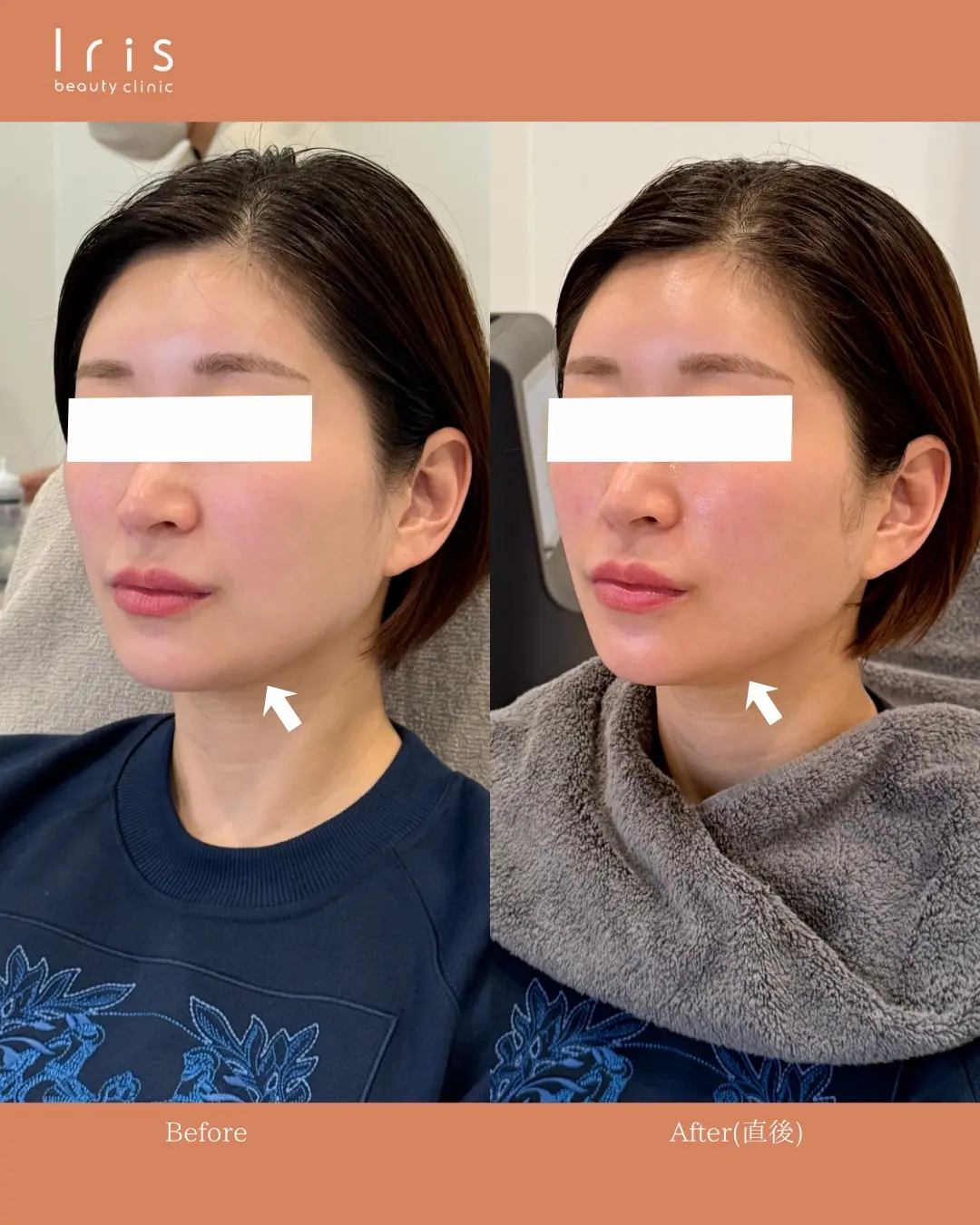 オリジオKISS(RF)300ショット×HIFUの症例