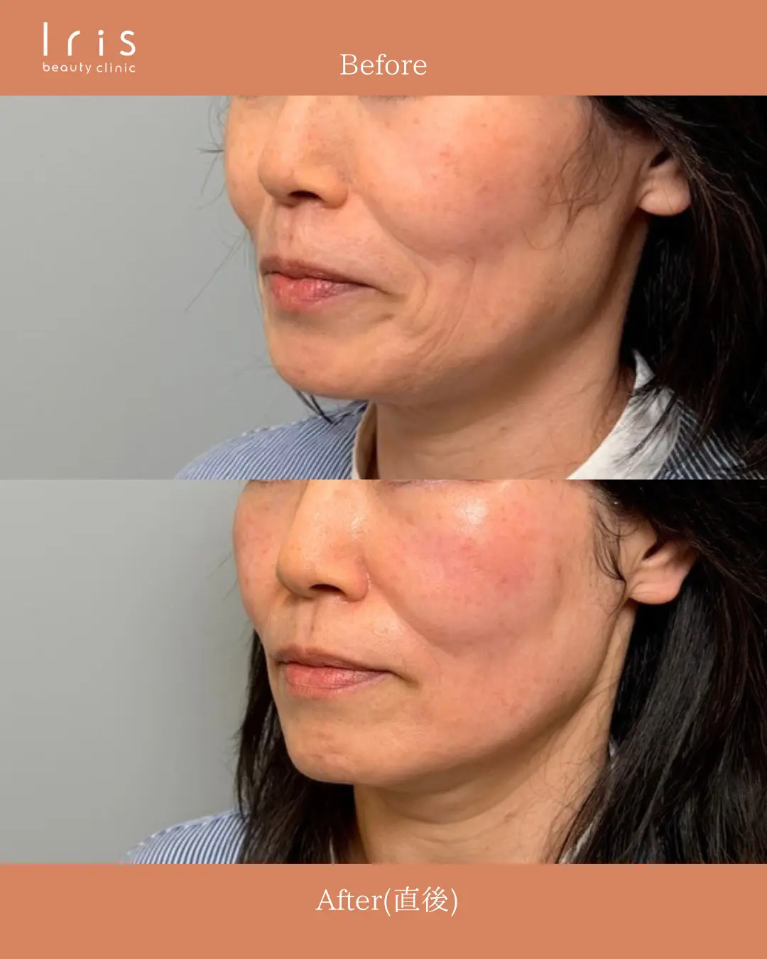 オリジオKISS(RF)300ショット×HIFUの症例