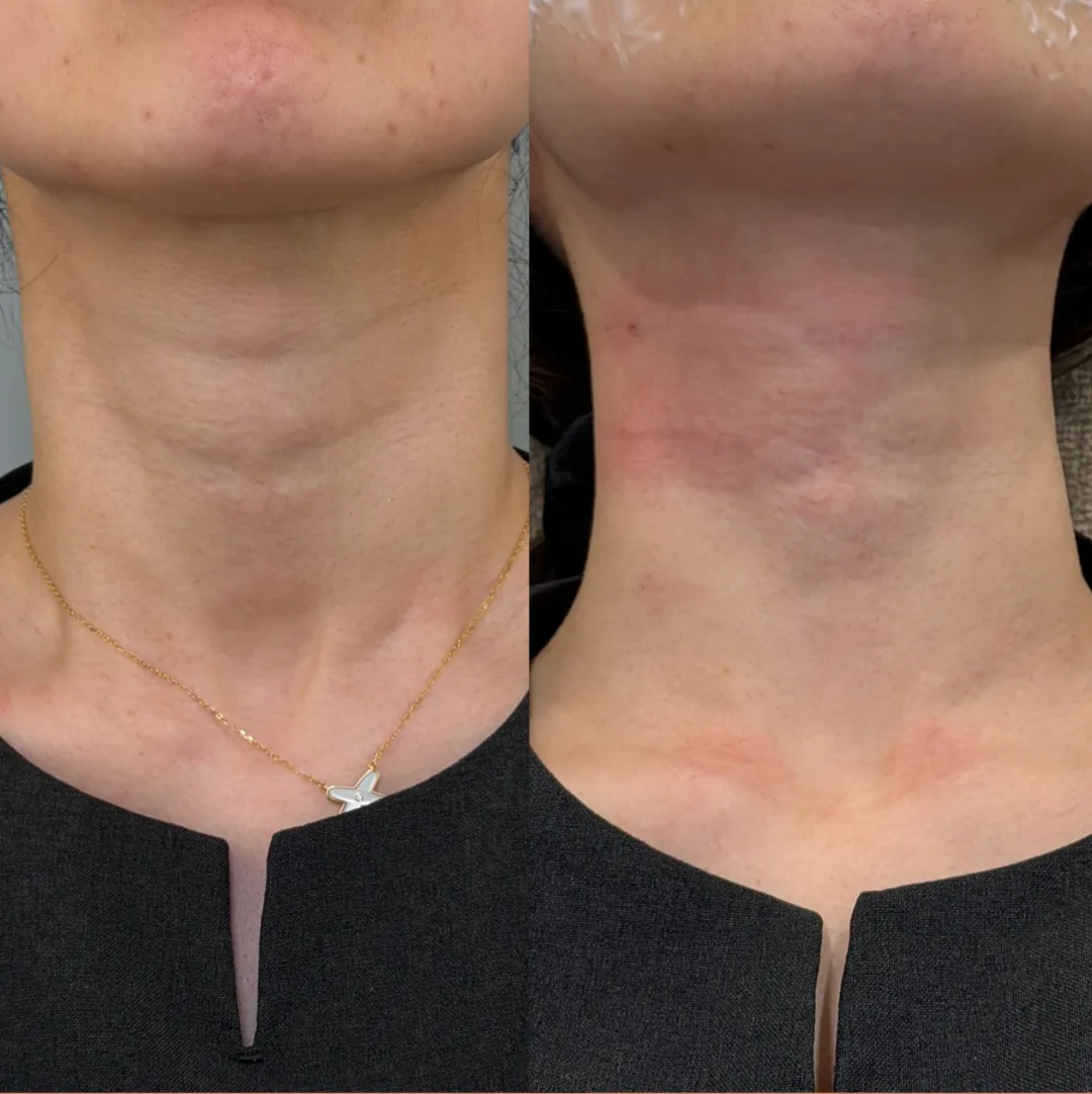 プルリアルバイオスカルプチャーのダウンタイム