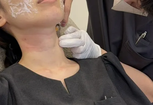 プルリアルバイオスカルプチャーの注入の様子