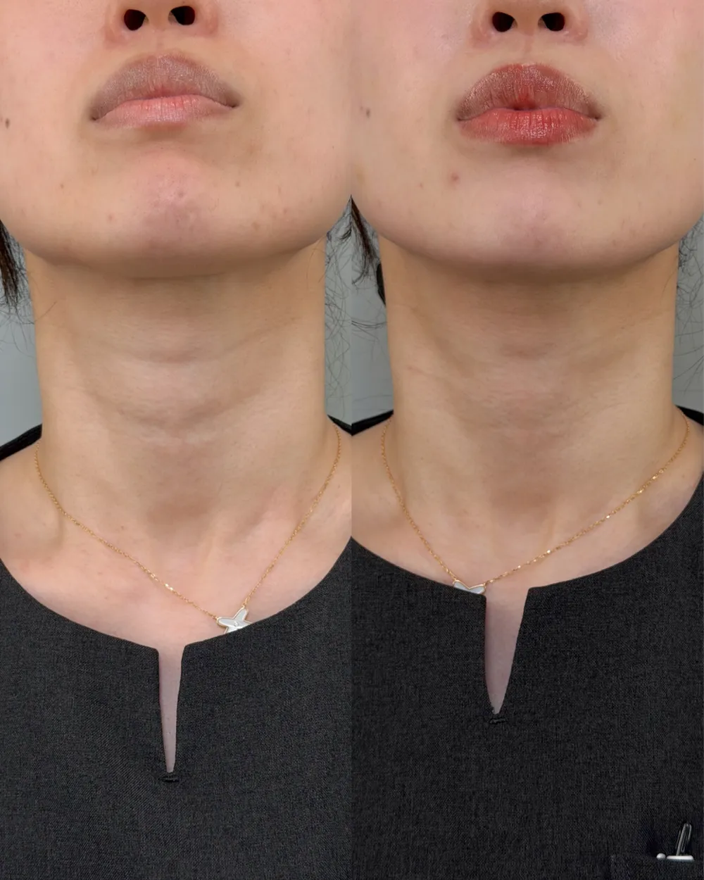 プルリアルバイオスカルプチャーの症例写真（アフター 1週間後）