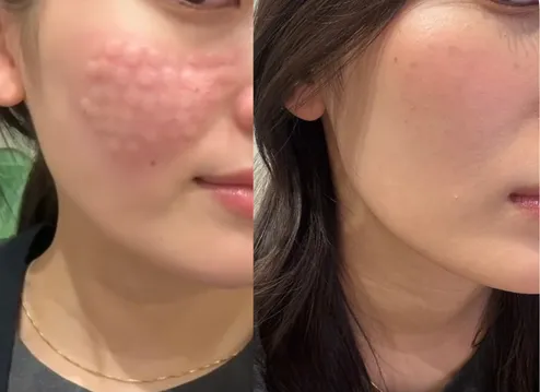 プルリアルデンシファイのダウンタイム