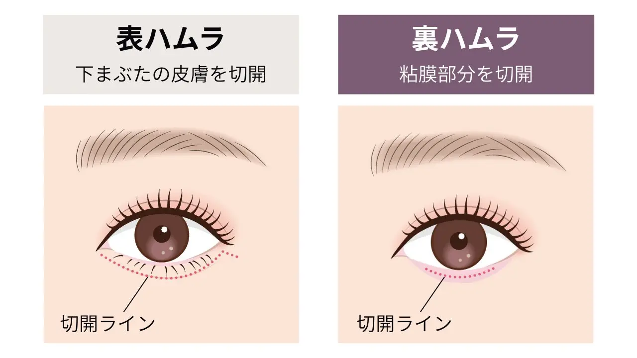 表ハムラと裏ハムラの違い