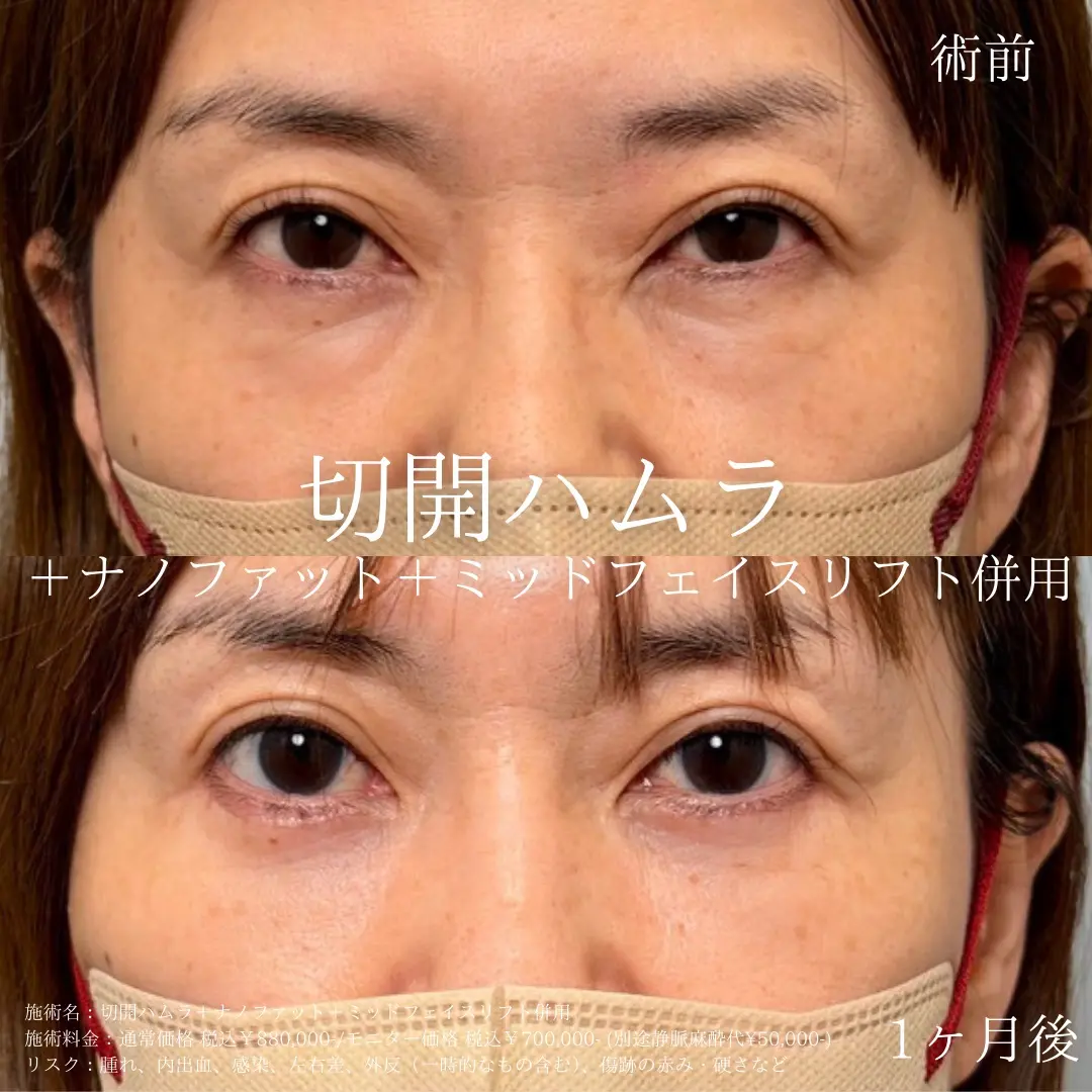 切開ハムラ法（表ハムラ）＋　ミッドフェイスリフト＋ナノファットの症例