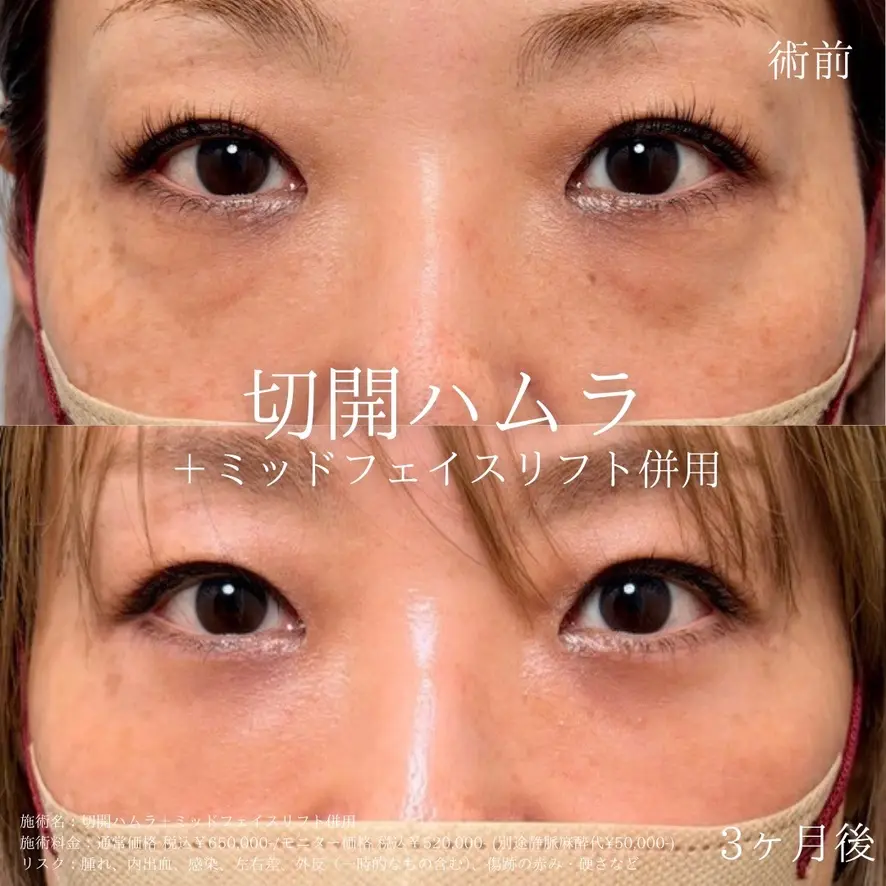 切開ハムラ＋ミッドフェイスリフト併用の症例