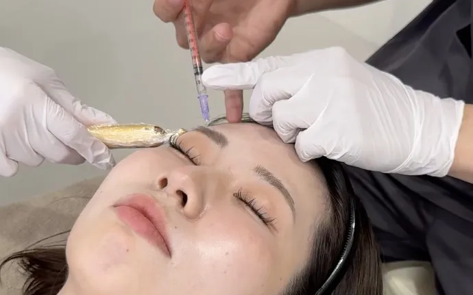 ボトックス注射の様子