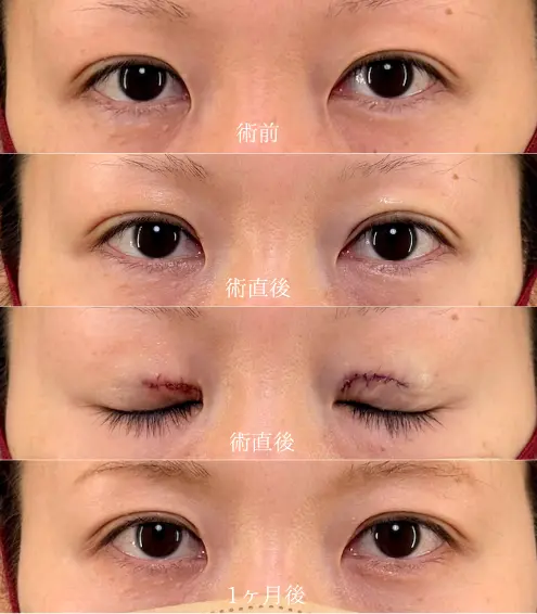 目上リフト（目上切開）術前/術後/１ヶ月後