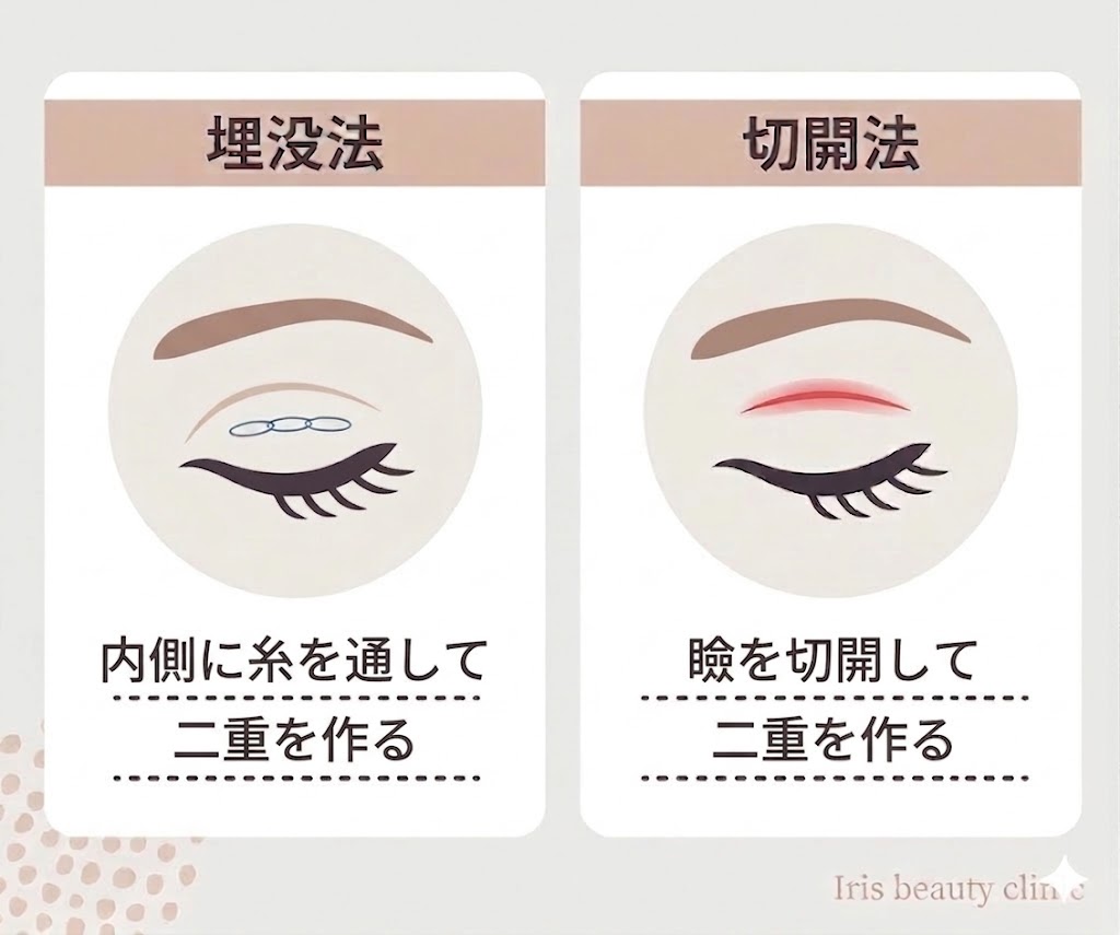 埋没法と全切開二重術の違いを示すイメージ