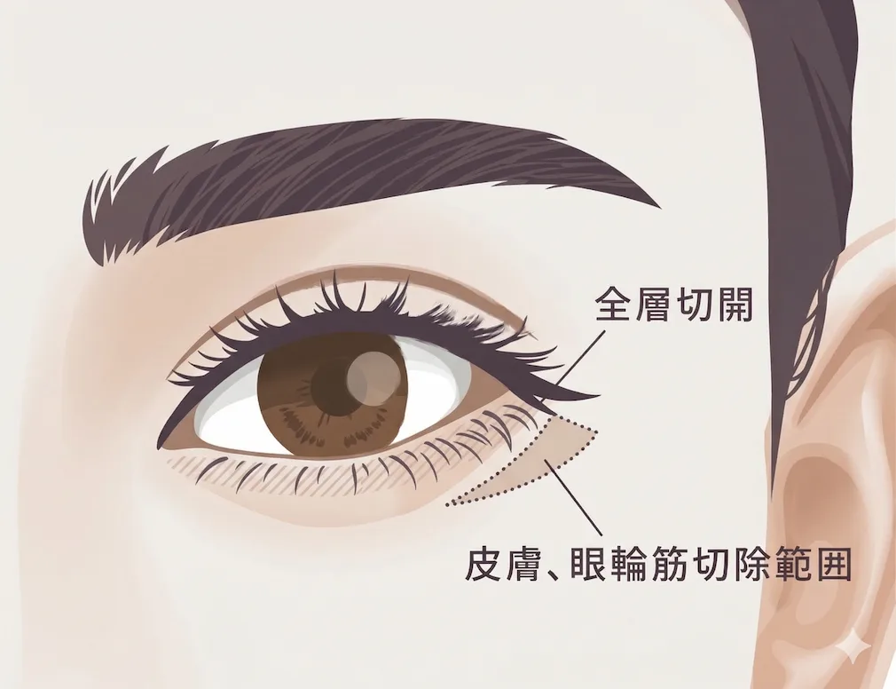 タレ目尻・グラマラスライン施術のイメージ