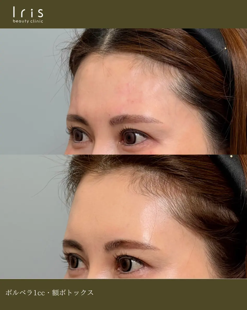 額ヒアルロン酸/額ボトックス　40代女性　症例写真　術前/術後1ヶ月