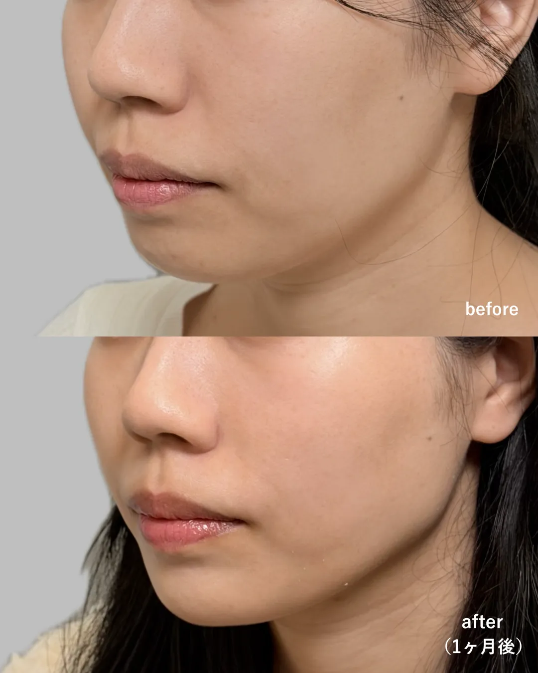 症例写真:シルキーリフト12本 + ボラックスC2/JW1、ボトックスビスタ小鼻/顎(1ヶ月後)
