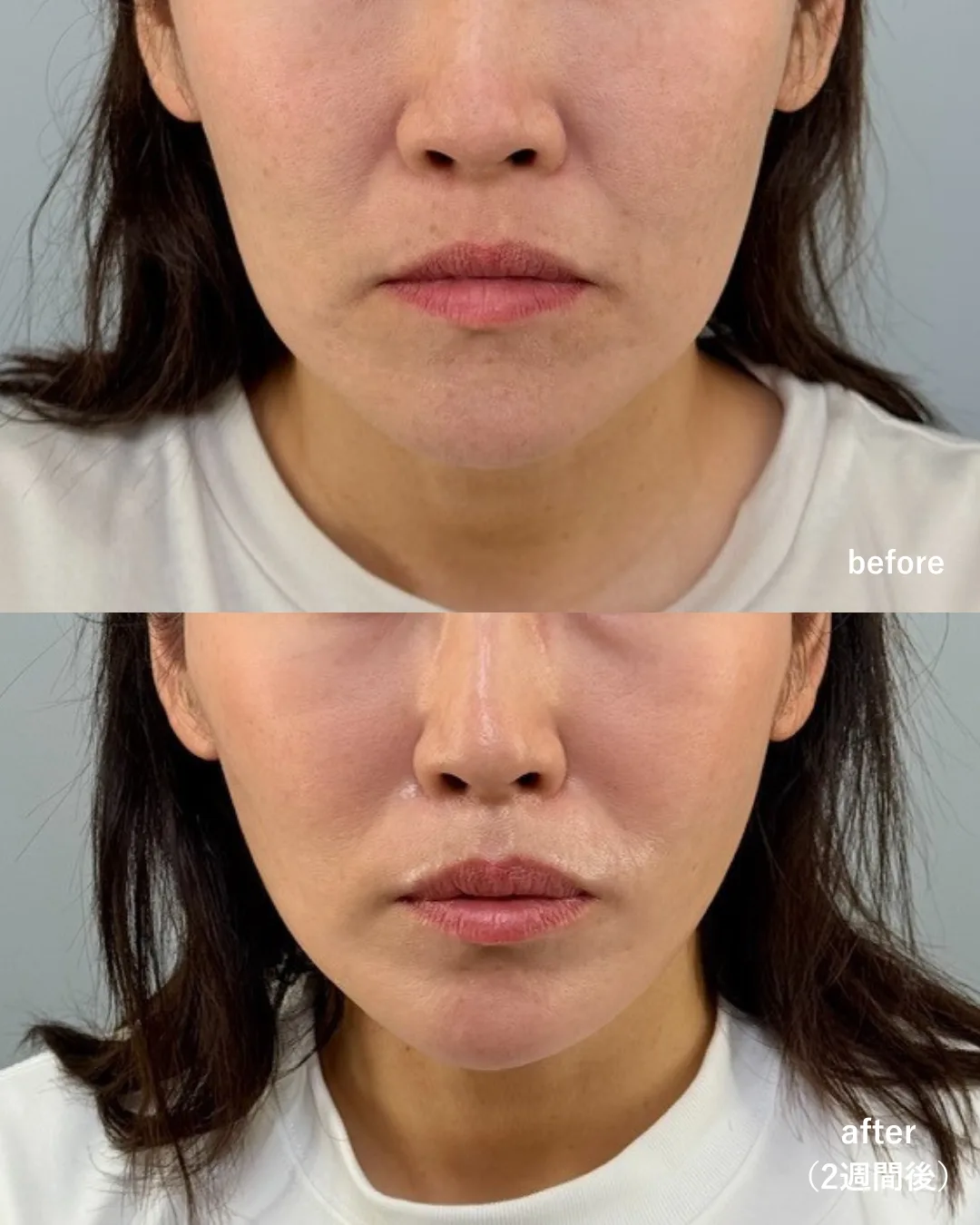 症例写真:シルキーリフト8本 + ボラックス顎/JW1、オーダーメイドボトックス(2週間後)