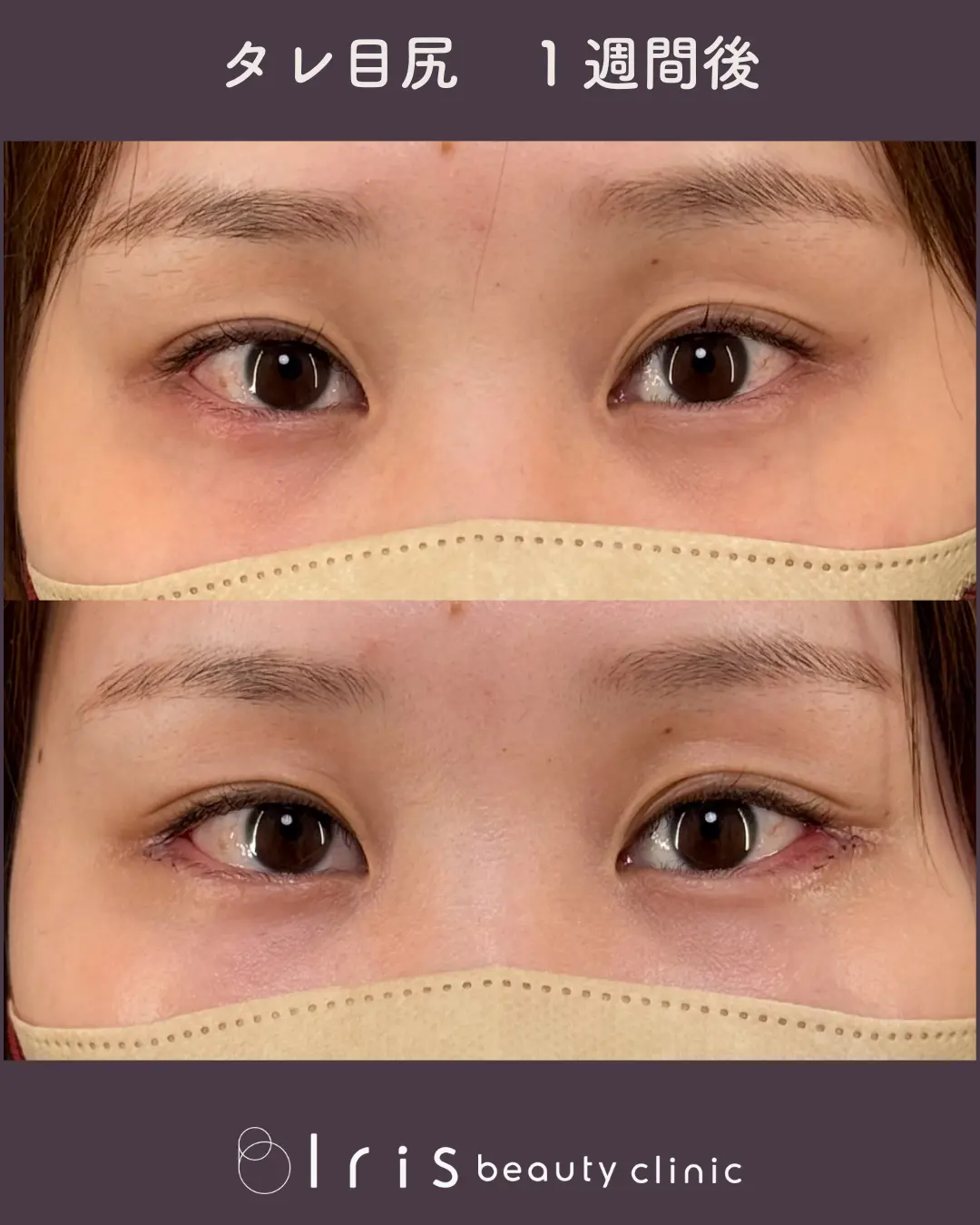 タレ目尻 症例写真 術前術後