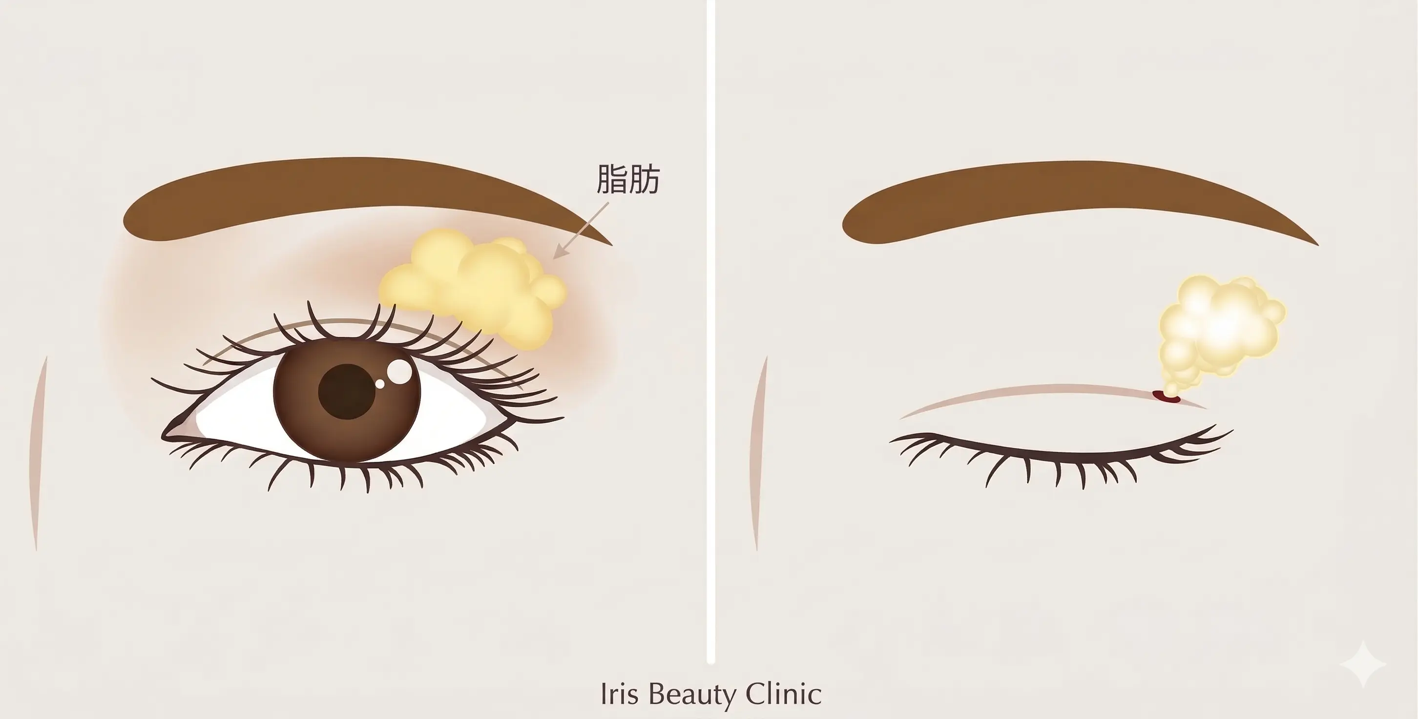 まぶたの脂肪取り(まぶたの画像)