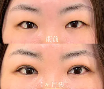 アイリスループトリプル+まぶたの脂肪取り 30代女性 症例写真
