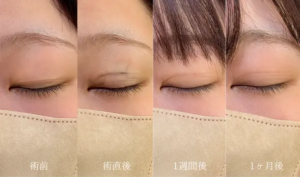 まぶたの脂肪取り 術後経過