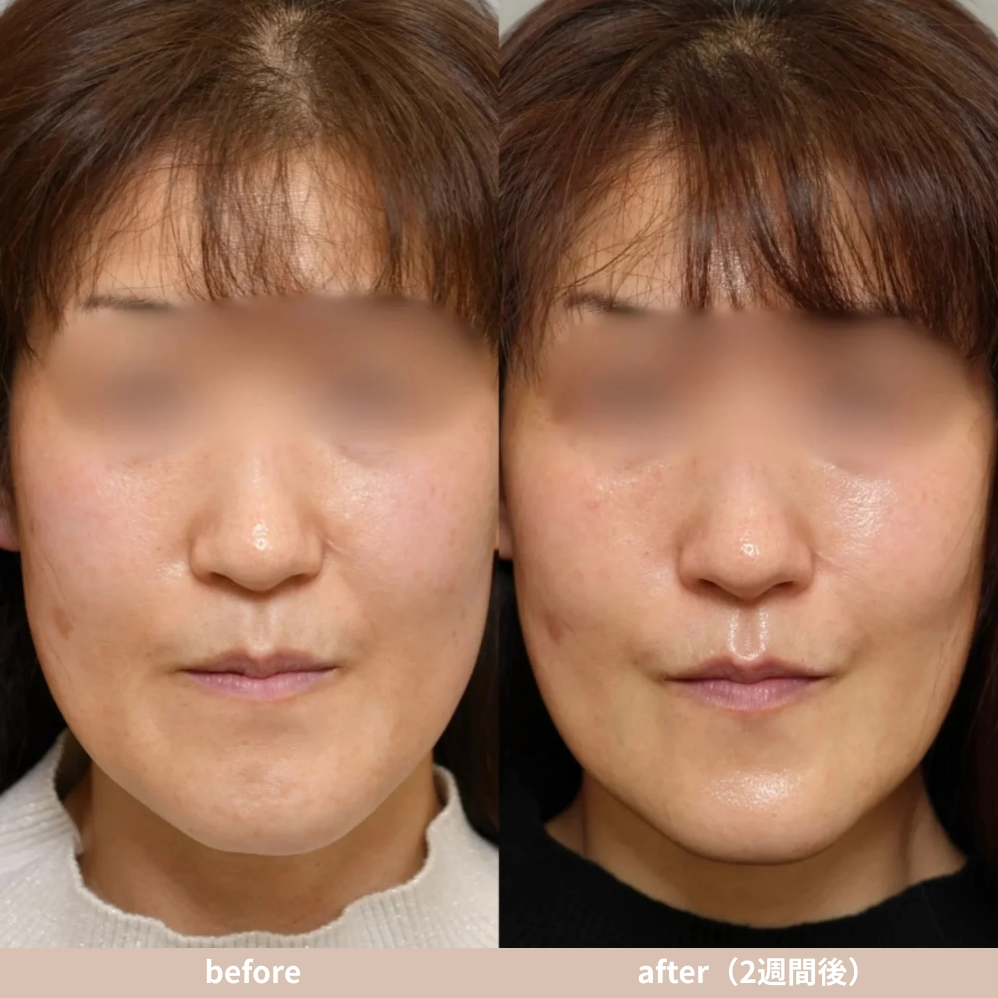 スキンバイブの症例写真