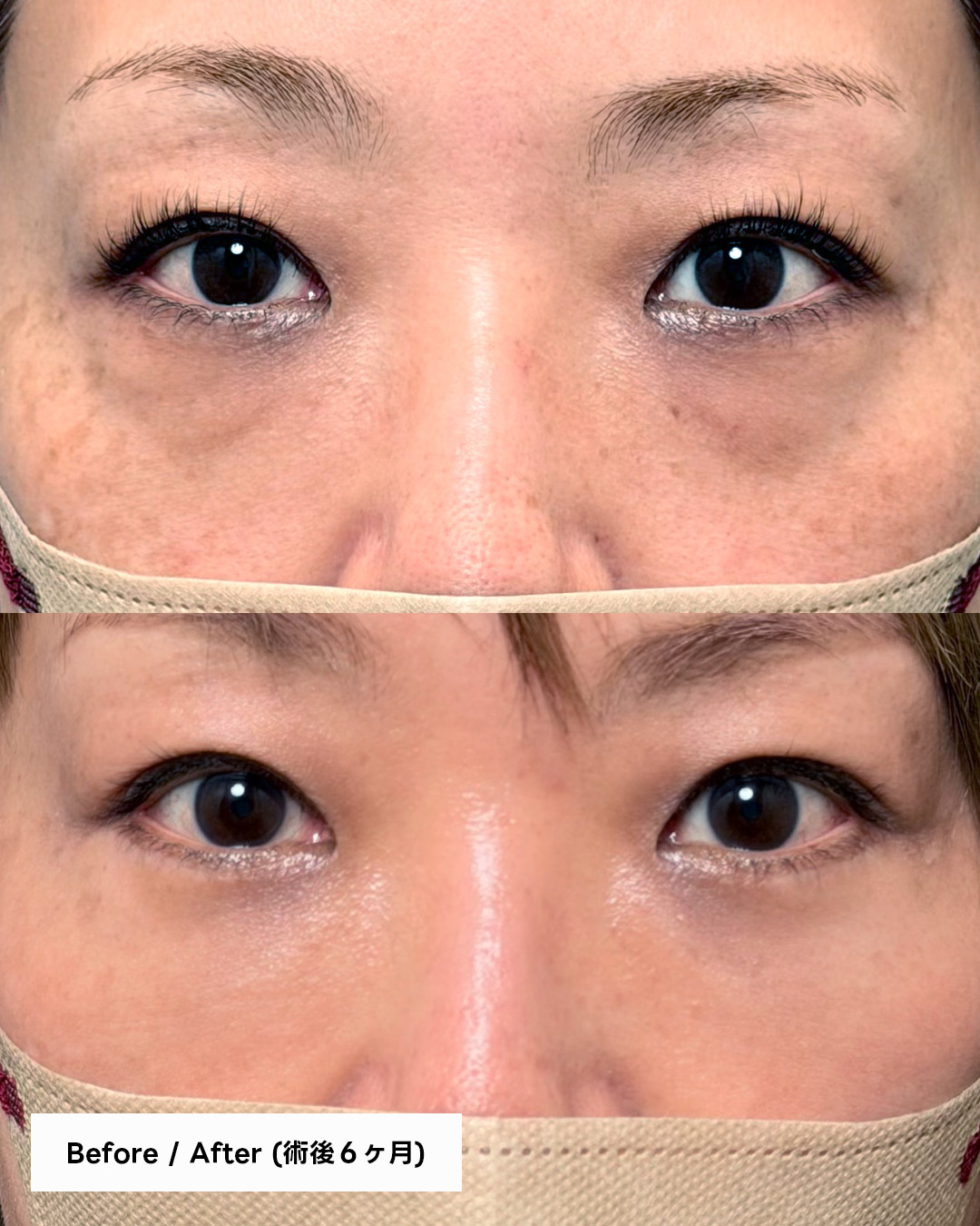 切開ハムラ+ミッドフェイスリフト｜術後6ヶ月