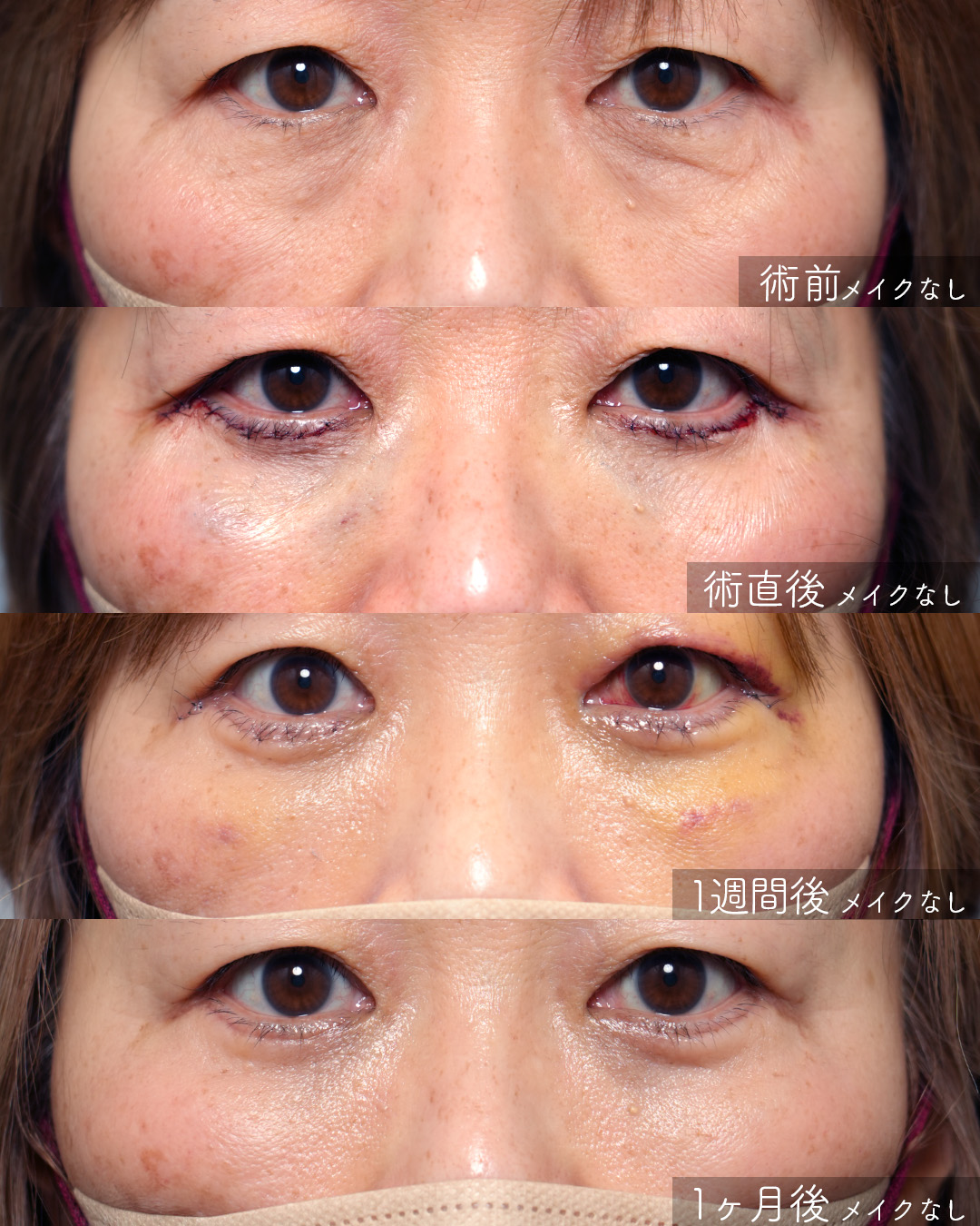 切開ハムラ+ミッドフェイスリフト｜術後1ヶ月 Before / After