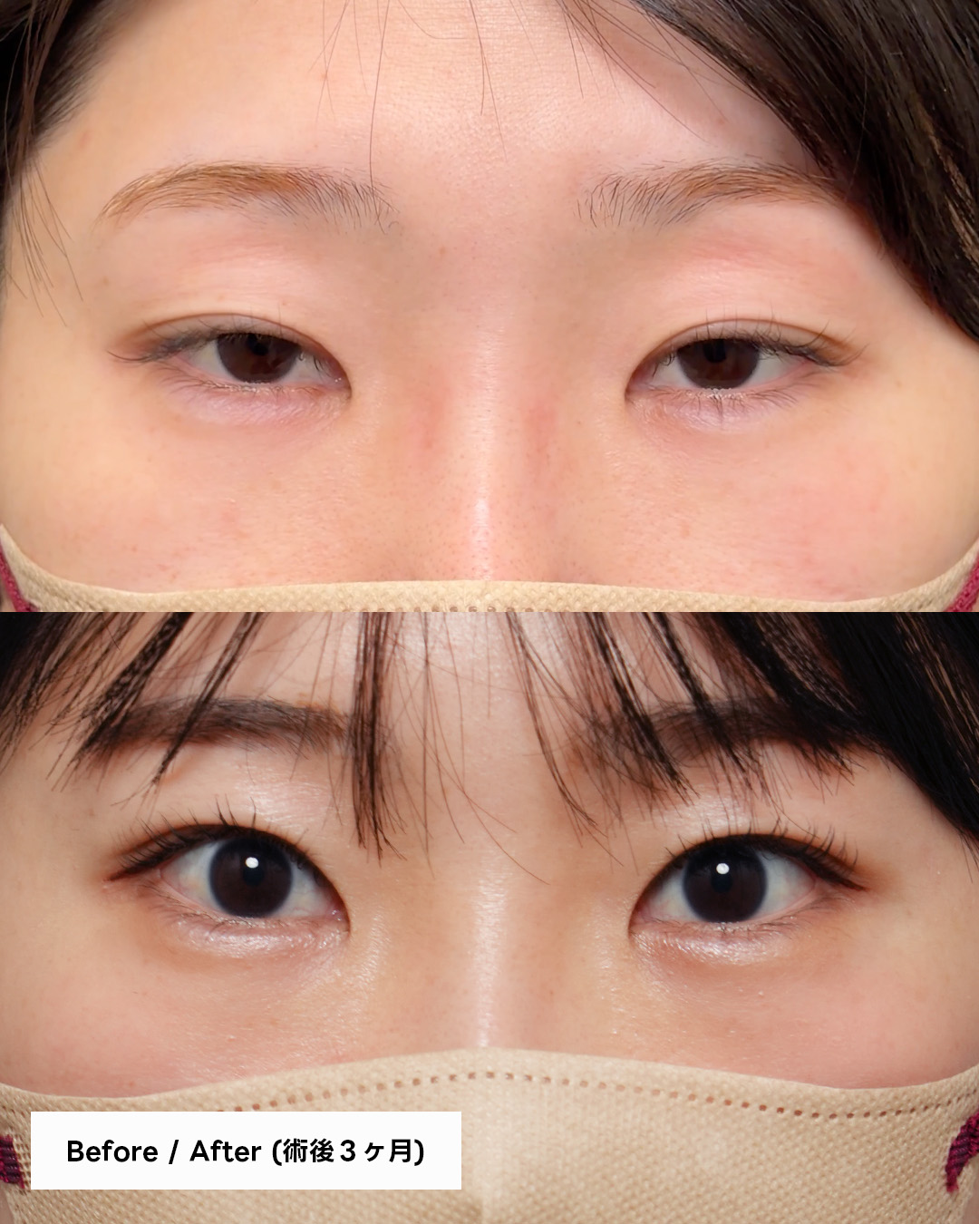 眼瞼下垂術＋たるみ取り併用｜術後3か月