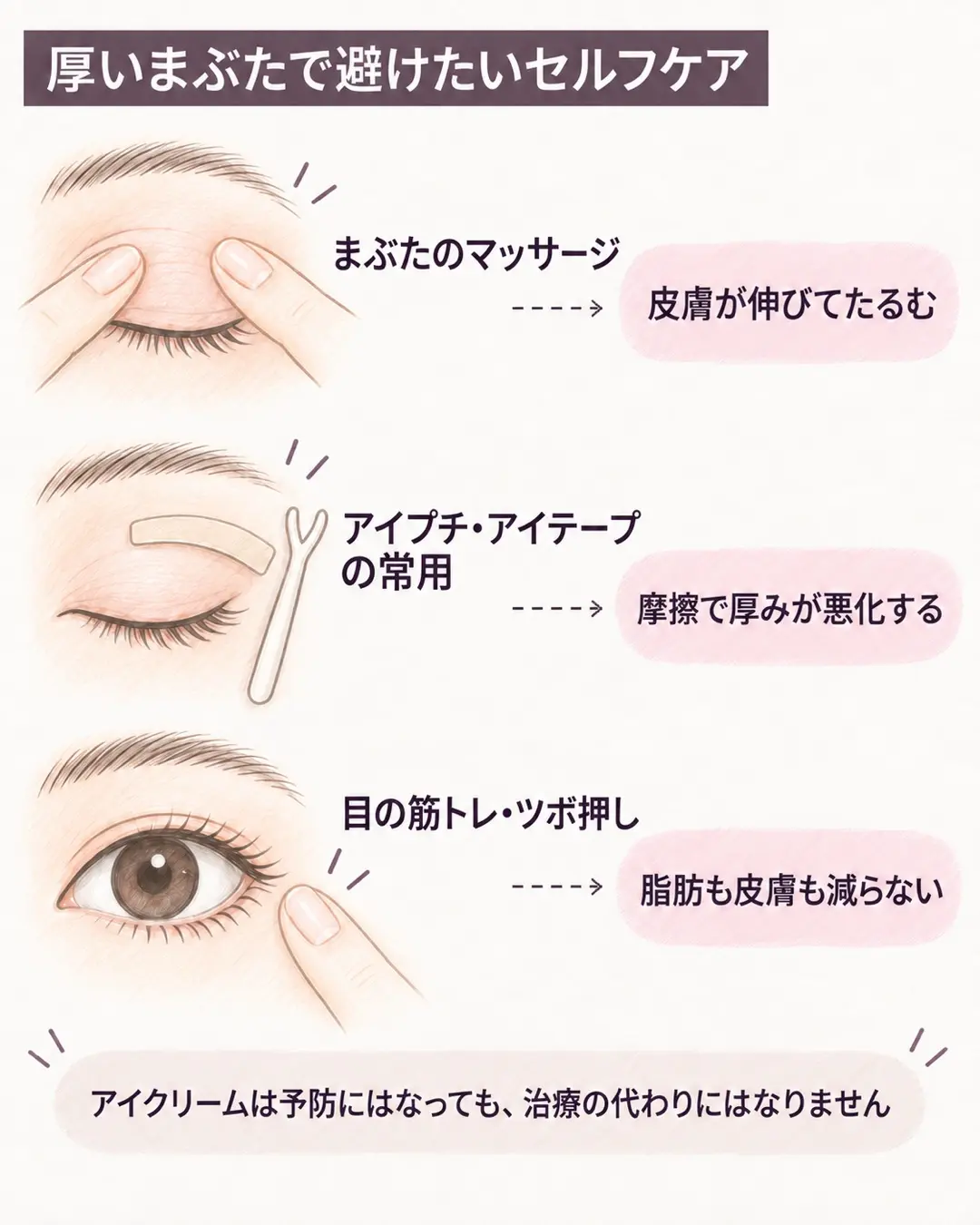 厚いまぶたで避けたいセルフケア。まぶたのマッサージは皮膚が伸びてたるむ、アイプチ・アイテープの常用は摩擦で厚みが悪化する、目の筋トレ・ツボ押しは脂肪も皮膚も減らない