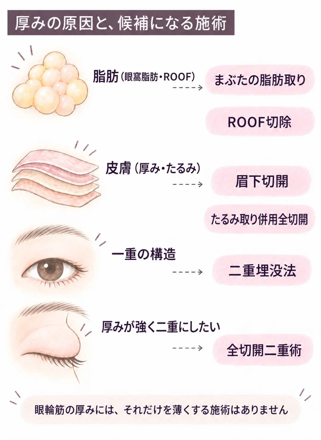 厚みの原因と候補になる施術の対応。脂肪はまぶたの脂肪取りとROOF切除、皮膚は眉下切開とたるみ取り併用全切開、一重の構造は二重埋没法、厚みが強く二重にしたい場合は全切開二重術